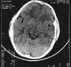 Epidural Hematoma