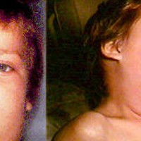 Pembesaran kelenjar parotis dan submandibular