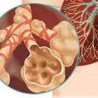 Emfisema : Pengertian, Sebab & Pengobatan